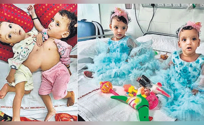 12:30 ತಾಸು ಶಸ್ತ್ರ ಚಿಕಿತ್ಸೆ ನಡೆಸಿ ಸಯಾಮಿ ಮಕ್ಕಳನ್ನು ಬೇರ್ಪಡಿಸಿದ ಏಮ್ಸ್ ವೈದ್ಯರು 12:30 ತಾಸು ಶಸ್ತ್ರ ಚಿಕಿತ್ಸೆ ನಡೆಸಿ ಸಯಾಮಿ ಮಕ್ಕಳನ್ನು ಬೇರ್ಪಡಿಸಿದ ಏಮ್ಸ್ ವೈದ್ಯರು