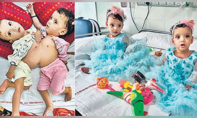 12:30 ತಾಸು ಶಸ್ತ್ರ ಚಿಕಿತ್ಸೆ ನಡೆಸಿ ಸಯಾಮಿ ಮಕ್ಕಳನ್ನು ಬೇರ್ಪಡಿಸಿದ ಏಮ್ಸ್‌ ವೈದ್ಯರು