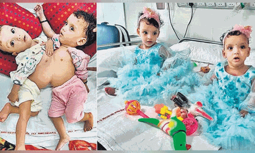 12:30 ತಾಸು ಶಸ್ತ್ರ ಚಿಕಿತ್ಸೆ ನಡೆಸಿ ಸಯಾಮಿ ಮಕ್ಕಳನ್ನು ಬೇರ್ಪಡಿಸಿದ ಏಮ್ಸ್‌ ವೈದ್ಯರು