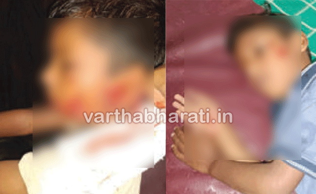 ಹಾಸನ: ಬೀದಿನಾಯಿ ದಾಳಿ; ಇಬ್ಬರು ಮಕ್ಕಳಿಗೆ ಗಂಭೀರ ಗಾಯ