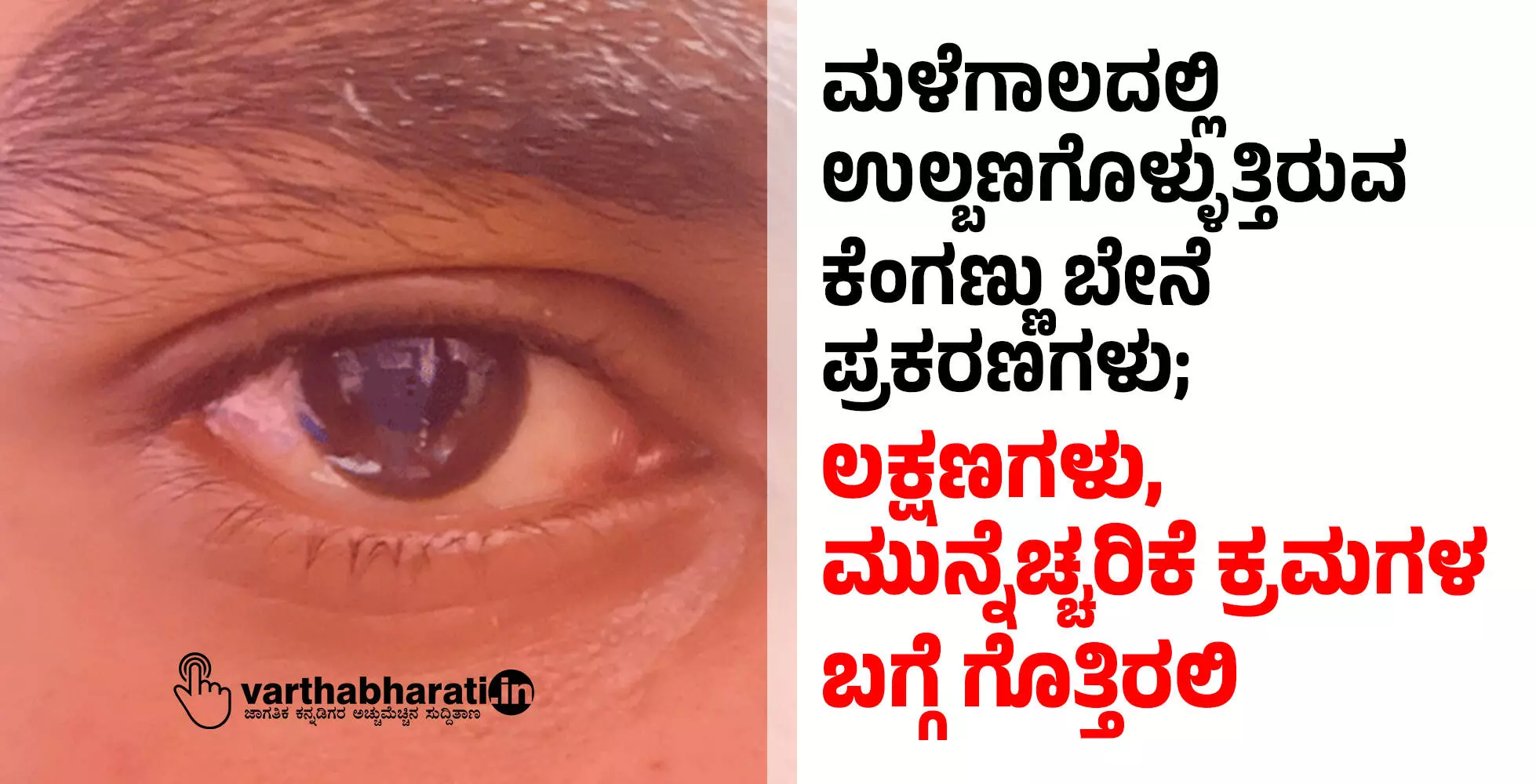 ಮಳೆಗಾಲದಲ್ಲಿ ಉಲ್ಬಣಗೊಳ್ಳುತ್ತಿರುವ ಕೆಂಗಣ್ಣು ಬೇನೆ ಪ್ರಕರಣಗಳು; ಲಕ್ಷಣಗಳು, ಮುನ್ನೆಚ್ಚರಿಕೆ ಕ್ರಮಗಳ ಬಗ್ಗೆ ಗೊತ್ತಿರಲಿ