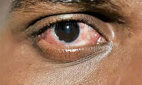 ಕೆಂಗಣ್ಣು ಕಾರಣಗಳು ಮತ್ತು ಚಿಕಿತ್ಸೆ