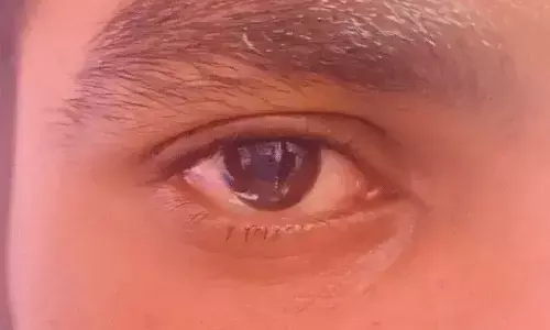 ಕೆಂಗಣ್ಣು ಗುಣವಾದ ಬಳಿಕ ಕಣ್ಣಿನ ಆರೋಗ್ಯಕ್ಕೆ ನೀವು ಮಾಡಬೇಕಾದ್ದೇನು?