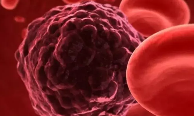 ಅಕಾಲಿಕ ಕ್ಯಾನ್ಸರ್ ಸಾವುಗಳ ಪೈಕಿ ಶೇ. 70ರಷ್ಟು ಪ್ರಕರಣಗಳನ್ನು ತಡೆಯಬಹುದಿತ್ತು; ಶೇ. 30 ಪ್ರಕರಣಗಳಿಗೆ ಚಿಕಿತ್ಸೆ ನೀಡಬಹುದಿತ್ತು: ಲ್ಯಾನ್ಸೆಟ್ ವರದಿ