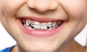 ಅ.5ರಿಂದ 12: ವಕ್ರದಂತ ಚಿಕಿತ್ಸಾ ಸಪ್ತಾಹ