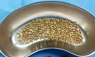 ಬೆಂಗಳೂರು| ಪಿತ್ತಜನಕಾಂಗದಿಂದ 345 ಕಲ್ಲುಗಳನ್ನು ಹೊರತೆಗೆದ ವೈದ್ಯರು