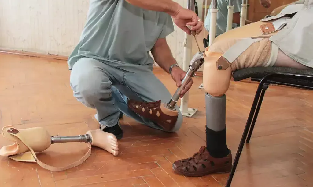 ಡಿ. 9,10: ಬಿ.ಸಿ.ರೋಡ್ ನಲ್ಲಿ ಉಚಿತ ಕೃತಕ ಕೈ ಕಾಲುಗಳ ಜೋಡಣಾ ಶಿಬಿರ