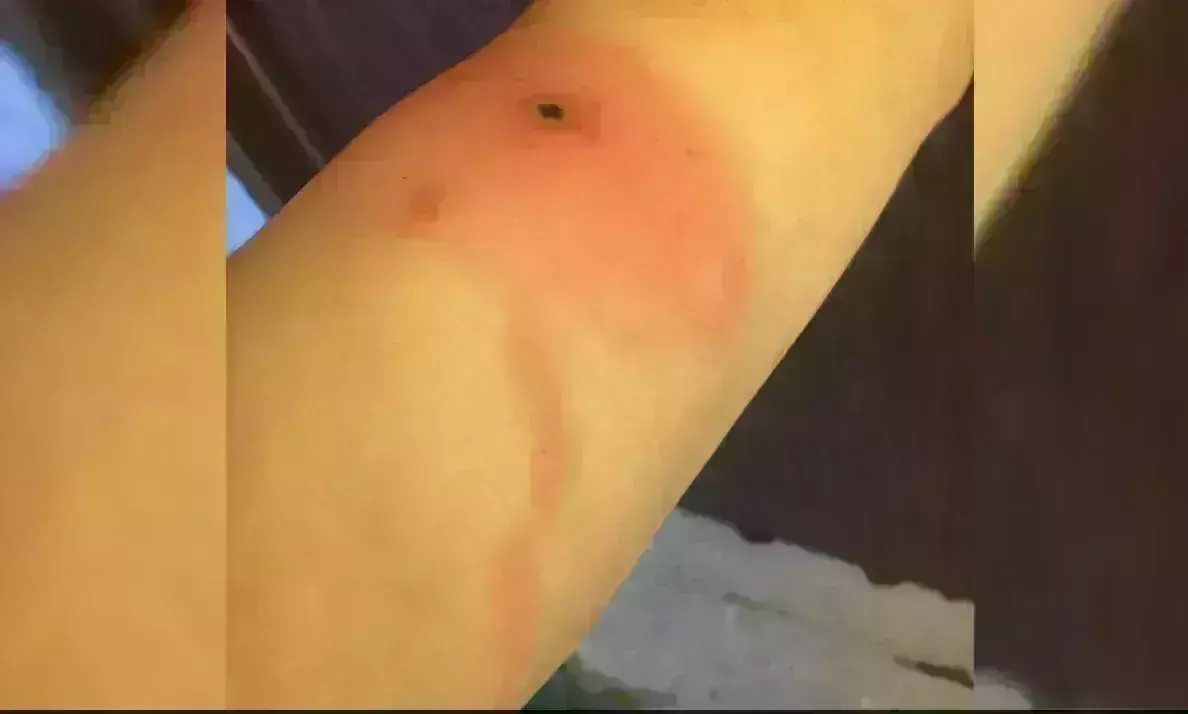 ಅಲಾಸ್ಕಪಾಕ್ಸ್ ಸೋಂಕು: ಮೊದಲ ಸಾವಿನ ಪ್ರಕರಣ ದಾಖಲು ಅಲಾಸ್ಕಪಾಕ್ಸ್ ಸೋಂಕು: ಮೊದಲ ಸಾವಿನ ಪ್ರಕರಣ ದಾಖಲು