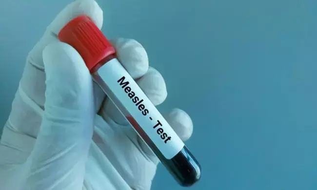 ಯುರೋಪ್‌ನಾದ್ಯಂತ ದಡಾರ ಪ್ರಕರಣಗಳಲ್ಲಿ ಭಾರೀ ಏರಿಕೆ