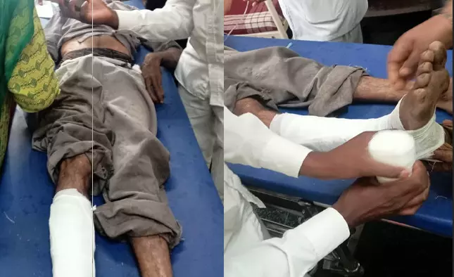 ಹಾಸನ | ಕಾಡಾನೆ ದಾಳಿಗೆ ವ್ಯಕ್ತಿಯ ಕಾಲು ಮುರಿತ