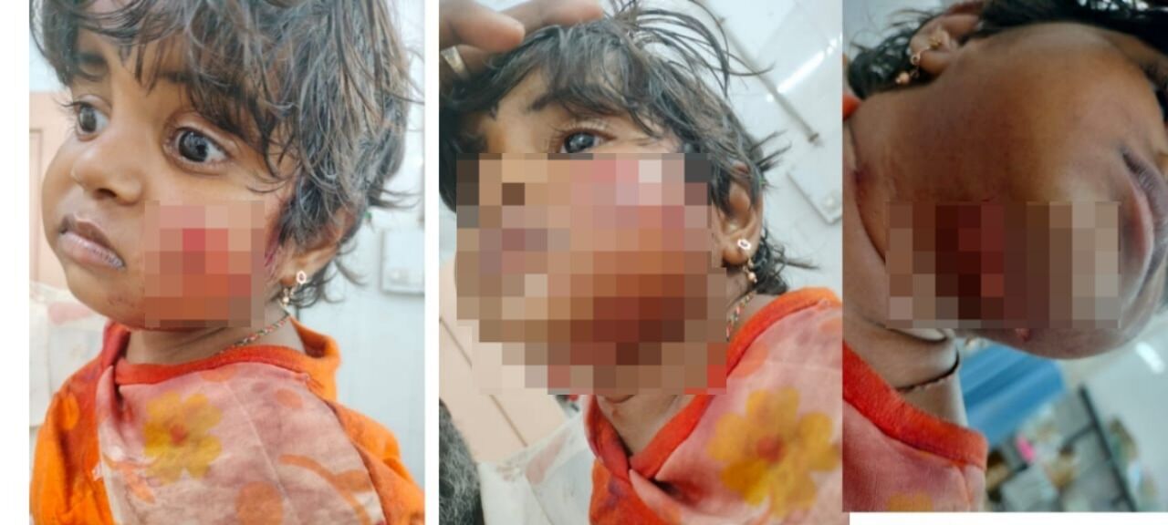 ಹೊಸಪೇಟೆ: ಹುಚ್ಚುನಾಯಿ ಕಡಿತ;  ಮಗುವಿಗೆ ಗಂಭೀರ ಗಾಯ