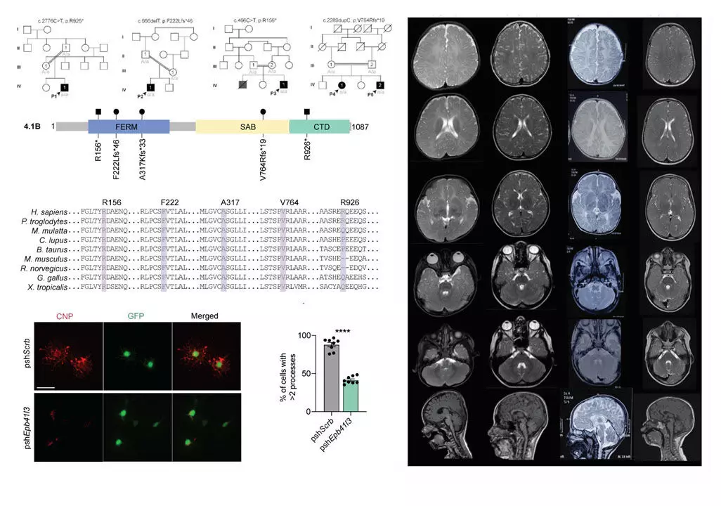 ಅನುವಂಶಿಕ ರೋಗಕ್ಕೆ ಜೀನ್ನ ನ್ಯೂನತೆಯನ್ನು ಪತ್ತೆ ಹಚ್ಚಿದ ಕೆಎಂಸಿಯ ಡಾ.ಅಂಜು ಶುಕ್ಲ ನೇತೃತ್ವದ ಅಂ.ರಾ.ವಿಜ್ಞಾನಿಗಳ ತಂಡ ಅನುವಂಶಿಕ ರೋಗಕ್ಕೆ ಜೀನ್ನ ನ್ಯೂನತೆಯನ್ನು ಪತ್ತೆ ಹಚ್ಚಿದ ಕೆಎಂಸಿಯ ಡಾ.ಅಂಜು ಶುಕ್ಲ ನೇತೃತ್ವದ ಅಂ.ರಾ.ವಿಜ್ಞಾನಿಗಳ ತಂಡ