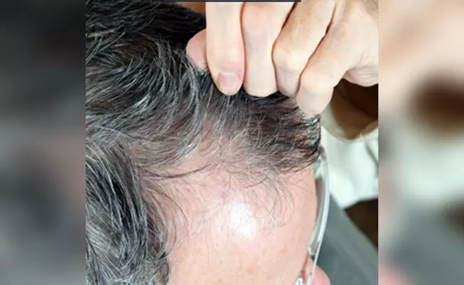 ಟ್ರೈಕೋ ಪೇಜಿಯಾ