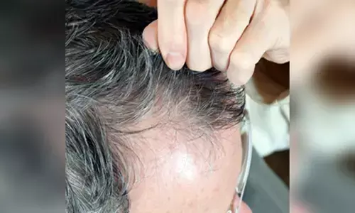 ಟ್ರೈಕೋ ಪೇಜಿಯಾ