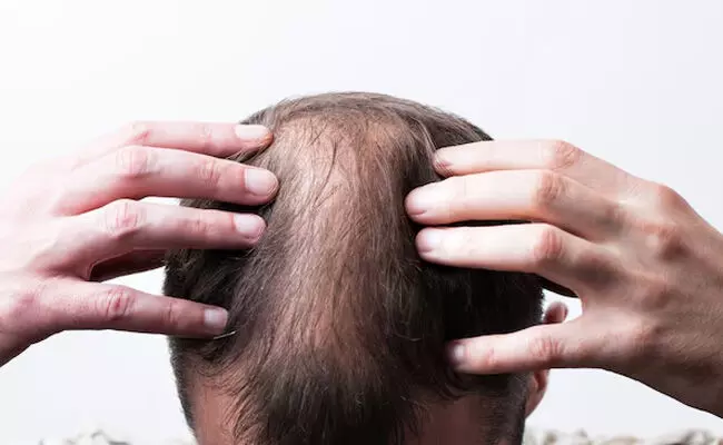 Photo of baldness Photo of baldness