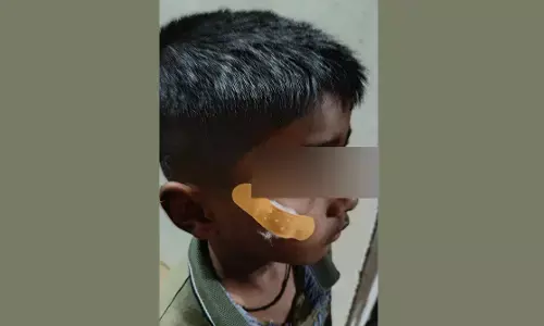 ಹಾವೇರಿ | ಬಾಲಕನ ಕೆನ್ನೆಯ ಗಾಯಕ್ಕೆ ಹೊಲಿಗೆ ಬದಲು ಫೆವಿಕ್ವಿಕ್ ಹಾಕಿದ ನರ್ಸ್ ಅಮಾನತು