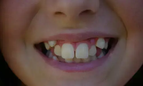 ಹಲ್ಲುಗಳು ಚಾಚಿಕೊಂಡಿರುವ ಕಾರಣಕ್ಕೆ ʼಸಮವಸ್ತ್ರಾಧಾರಿತ ಹುದ್ದೆʼಗಳಿಗೆ ಅಭ್ಯರ್ಥಿಗಳ ಅನರ್ಹತೆ ರದ್ದು: ಕೇರಳ ಸರಕಾರ ಮಹತ್ವದ ನಿರ್ಧಾರ