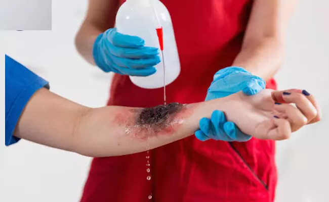 ದೇಶದಲ್ಲಿ ಪ್ರತಿವರ್ಷ 20 ಲಕ್ಷಕ್ಕೂ ಅಧಿಕ ಸುಟ್ಟ ಗಾಯಾಳುಗಳು: ವರದಿ ದೇಶದಲ್ಲಿ ಪ್ರತಿವರ್ಷ 20 ಲಕ್ಷಕ್ಕೂ ಅಧಿಕ ಸುಟ್ಟ ಗಾಯಾಳುಗಳು: ವರದಿ