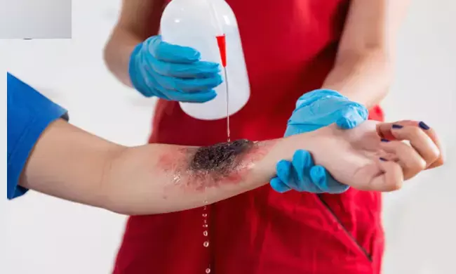 ದೇಶದಲ್ಲಿ ಪ್ರತಿವರ್ಷ 20 ಲಕ್ಷಕ್ಕೂ ಅಧಿಕ ಸುಟ್ಟ ಗಾಯಾಳುಗಳು: ವರದಿ