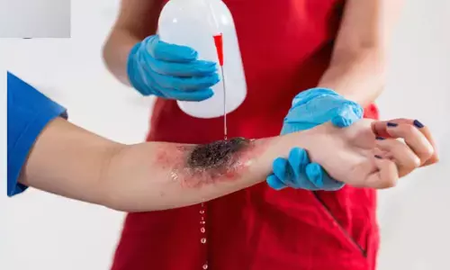 ದೇಶದಲ್ಲಿ ಪ್ರತಿವರ್ಷ 20 ಲಕ್ಷಕ್ಕೂ ಅಧಿಕ ಸುಟ್ಟ ಗಾಯಾಳುಗಳು: ವರದಿ