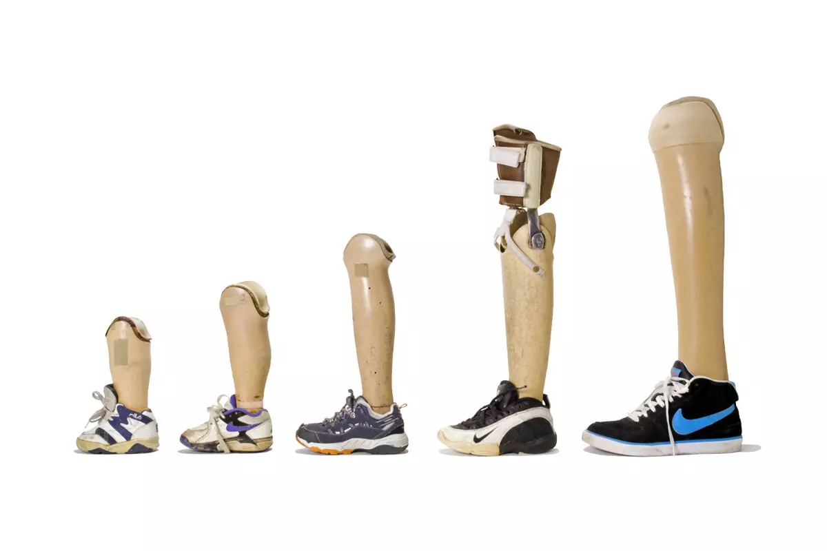 ಮುಡಿಪು: ಕೃತಕ ಕಾಲು, ಕೈ ಜೋಡಣೆಗೆ ಅವಕಾಶ