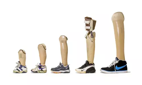 ಮುಡಿಪು: ಕೃತಕ ಕಾಲು, ಕೈ ಜೋಡಣೆಗೆ ಅವಕಾಶ