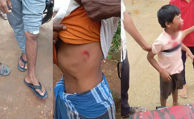 ಕೊಪ್ಪಳ | 20ಕ್ಕೂ ಹೆಚ್ಚು ಜನರ ಮೇಲೆ ಬೀದಿ ನಾಯಿಗಳಿಂದ ದಾಳಿ: ಓರ್ವ ಬಾಲಕನಿಗೆ ಗಂಭೀರ ಗಾಯ