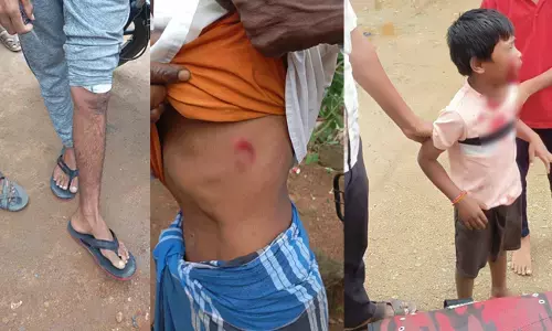 ಕೊಪ್ಪಳ | 20ಕ್ಕೂ ಹೆಚ್ಚು ಜನರ ಮೇಲೆ ಬೀದಿ ನಾಯಿಗಳಿಂದ ದಾಳಿ: ಓರ್ವ ಬಾಲಕನಿಗೆ ಗಂಭೀರ ಗಾಯ