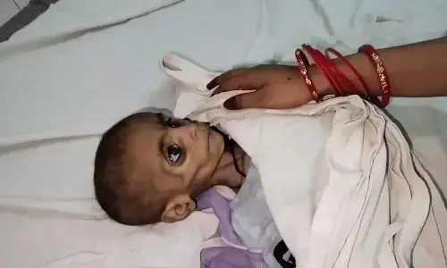 ಮಧ್ಯಪ್ರದೇಶ | ಅಪೌಷ್ಟಿಕತೆಯಿಂದ ಮತ್ತೊಂದು ಮಗು ಮೃತ್ಯು, ಪುನರ್ವಸತಿ ಕೇಂದ್ರಗಳ ದಾಖಲಾತಿಗಳಲ್ಲೂ ಹೆಚ್ಚಳ!