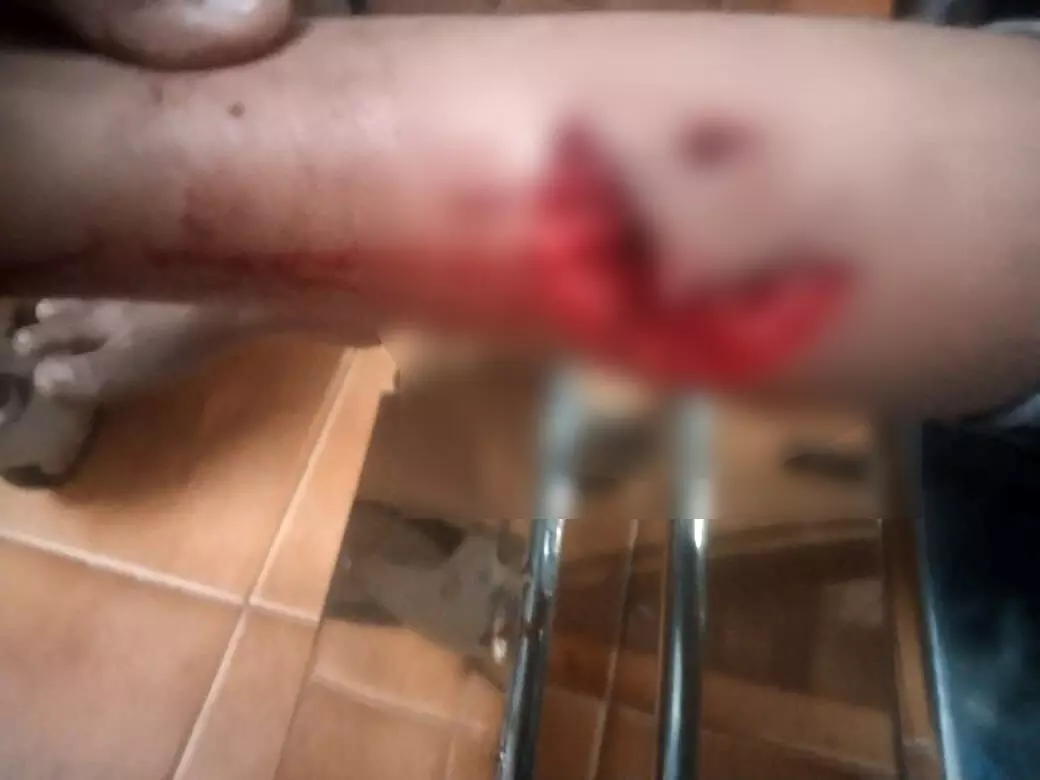 ಮಂಜೇಶ್ವರ: ಮದ್ರಸಕ್ಕೆ ತೆರಳುತ್ತಿದ್ದ ಬಾಲಕನ ಮೇಲೆ ಬೀದಿನಾಯಿ ದಾಳಿ