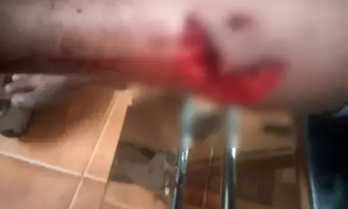 ಮಂಜೇಶ್ವರ: ಮದ್ರಸಕ್ಕೆ ತೆರಳುತ್ತಿದ್ದ ಬಾಲಕನ ಮೇಲೆ ಬೀದಿನಾಯಿ ದಾಳಿ