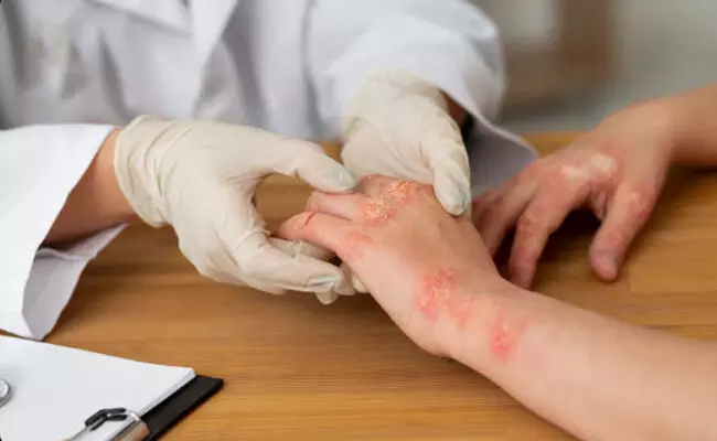 ಒಬಿಸಿ-ಅಲ್ಪಸಂಖ್ಯಾತರ ವಸತಿ ಶಾಲಾ ಮಕ್ಕಳಿಗೆ ಅಂಟಿದ ಚರ್ಮರೋಗ