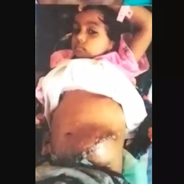 ಕಿಡ್ನಿ, ಅನ್ನನಾಳ, ಮಲದ್ವಾರ ಸಮಸ್ಯೆಯಿಂದ ಬಳಲುವ ತಂಝೀಮ್‌ಗೆ ನೆರವು ನೀಡಲು ಮನವಿ