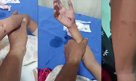 ಸುರತ್ಕಲ್: ಬೀದಿನಾಯಿಗಳ ದಾಳಿ; ಬಾಲಕಿಗೆ ಗಂಭೀರ ಗಾಯ