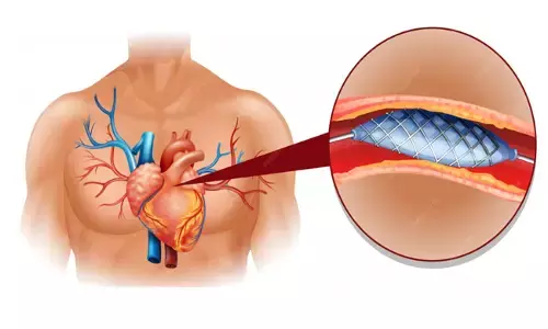 ಸ್ವದೇಶಿ ನಿರ್ಮಿತ ಹೃದಯದ ಸ್ಟೆಂಟ್‌ಗೆ ಜಾಗತಿಕ ಮನ್ನಣೆ : ಅಮೆರಿಕದ ಸಾಧನಕ್ಕಿಂತ ಉತ್ತಮ ನಿರ್ವಹಣೆ ಪ್ರದರ್ಶಿಸಿದ ಭಾರತದ ‘ಸುಪ್ರಾಫ್ಲೆಕ್ಸ್’