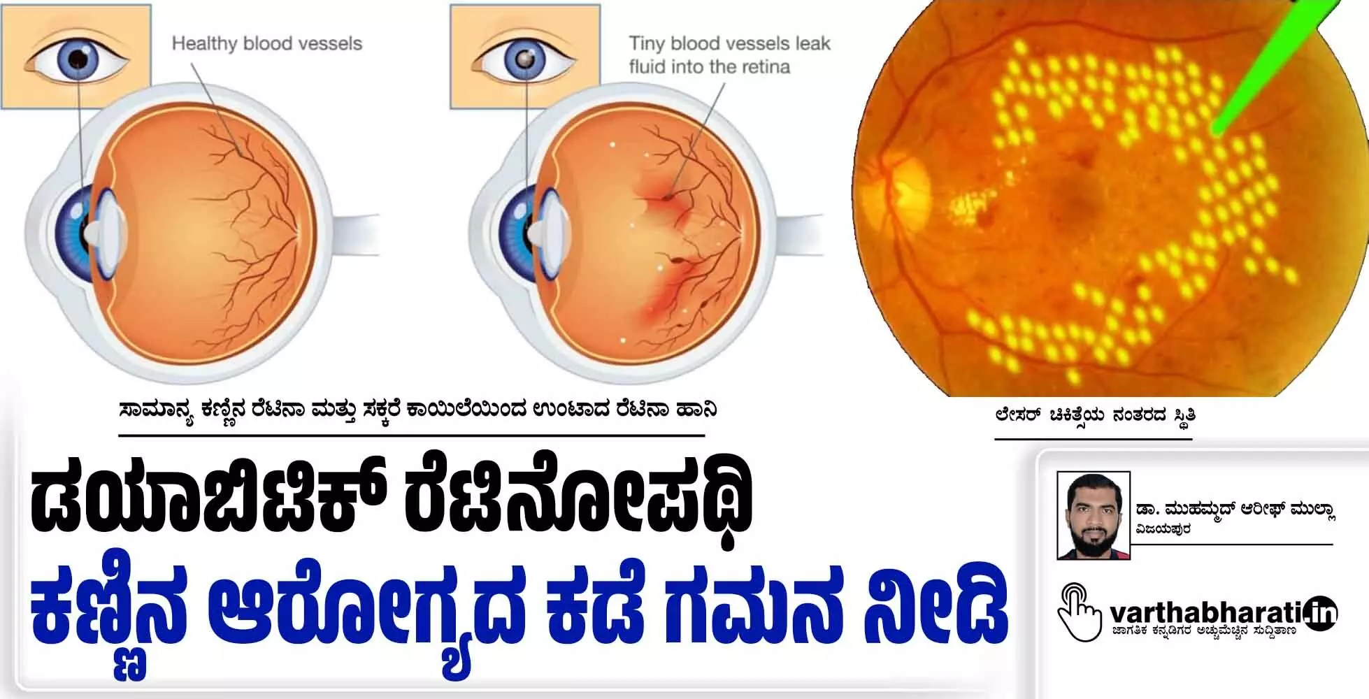 ಡಯಾಬಿಟಿಕ್ ರೆಟಿನೋಪಥಿ ಕಣ್ಣಿನ ಆರೋಗ್ಯದ ಕಡೆ ಗಮನ ನೀಡಿ