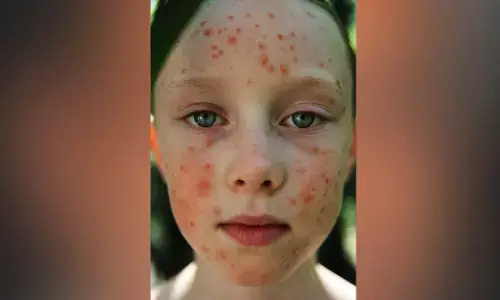 ದ.ಕ.ಜಿಲ್ಲೆಯಲ್ಲಿ ಚಿಕನ್ ಪಾಕ್ಸ್ ಪ್ರಕರಣ ಪತ್ತೆ : ಮುನ್ನೆಚ್ಚರ ವಹಿಸಲು ಸೂಚನೆ