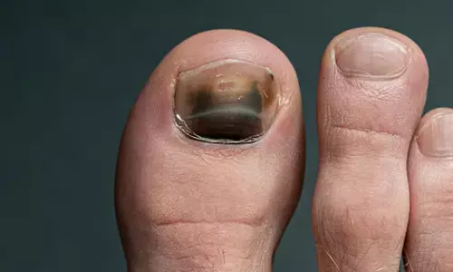 ಕಾಲಿನ ಉಗುರು ಕಪ್ಪಾಗಿದೆಯೆ? ಈ ಬಗ್ಗೆ ವೈದ್ಯರು ಏನು ಹೇಳುತ್ತಾರೆ?