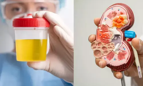 ಕಂದುಬಣ್ಣದ ಮೂತ್ರ ಕಂಡುಬಂದರೆ ಭಯ ಪಡಬೇಕೆ?