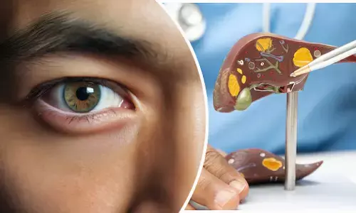 ಕಣ್ಣಿನ ಸುತ್ತ ಕಪ್ಪು ಕಲೆಗೆ ಲಿವರ್ ಪರೀಕ್ಷೆ ಮಾಡಿಸಿಕೊಳ್ಳಬೇಕೆ?