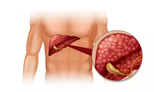 ಜೀವನಶೈಲಿ ಬದಲಾವಣೆಯಿಂದ ಮಾತ್ರವೇ MASLD ಗೆ ಪರಿಹಾರ!
