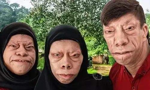 ಅಪರೂಪದ ಅನುವಂಶಿಕ ಅಸ್ವಸ್ಥತೆ ಬಗ್ಗೆ ಜಾಗೃತಿ ಮೂಡಿಸುತ್ತಿರುವ ಇಂಡೋನೇಷ್ಯಾದ ಮನುರುಂಗ್ ಮನೆತನ