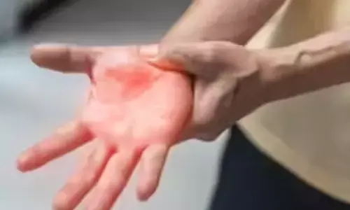 ಮಧ್ಯಪ್ರದೇಶ| ‘ಗೀಲನ್ ಬಾ’ ಸೋಂಕಿಗೆ ಇಬ್ಬರು ಮಕ್ಕಳು ಮೃತ್ಯು