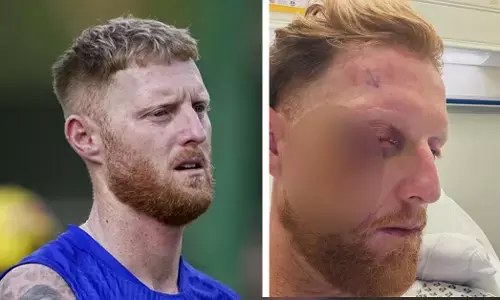 ಚೆಂಡು ಮುಖಕ್ಕೆ ಬಡಿದು ಗಂಭೀರ ಗಾಯ: ಶಸ್ತ್ರಚಿಕಿತ್ಸೆಗೆ ಒಳಗಾದ ಬೆನ್ ಸ್ಟೋಕ್ಸ್