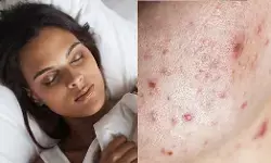 ಮೊಡವೆಯಿಂದ ಪ್ರಾರಂಭಿಸಿ ನಿದ್ರೆಯವರೆಗೆ ಕರುಳಿನ ಆರೋಗ್ಯದ 7 ಚಿಹ್ನೆಗಳನ್ನು ಕಡೆಗಣಿಸಬೇಡಿ…