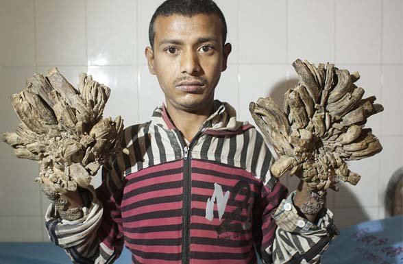 ಬಾಂಗ್ಲಾದೇಶದ: ಯುವಕನೊಬ್ಬನ ಕೈಕಾಲೆರಡರಲ್ಲಿ ಬೇರುಗಳ ಸ್ಥಿತಿಯಲ್ಲಿ ಬೆರಳುಗಳು.