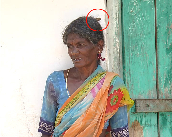 ವೈದ್ಯ ಲೋಕಕ್ಕೆ ಸವಾಲಾದ ಮಹಿಳೆಯ ತಲೆಮೇಲಿನ ಕೊಂಬು!