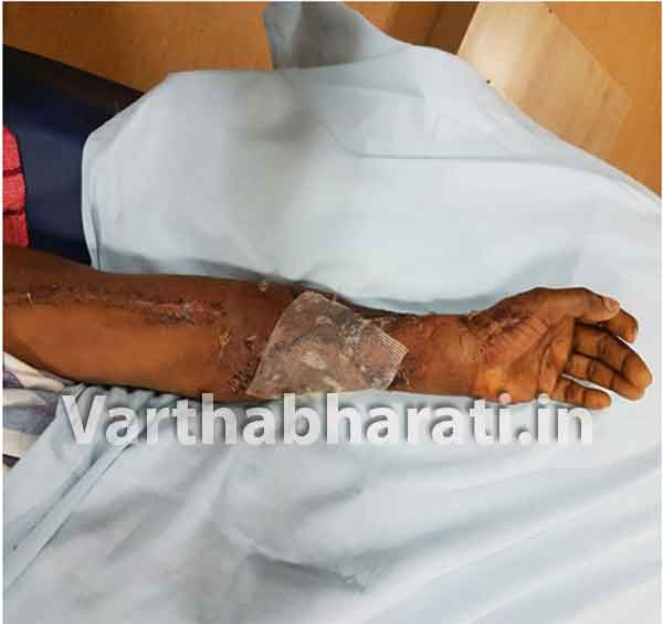 ಯುನಿಟಿ ಆಸ್ಪತ್ರೆ: ತುಂಡಾದ ಮುಂಗೈಯ ಯಶಸ್ವಿ ಜೋಡಣೆ