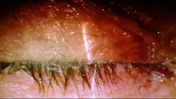 ಕಡಿಮೆ ಸಂಪಾದಿಸುವ ಕೋಪದಲ್ಲಿ ನಿದ್ರಿಸುತ್ತಿದ್ದ ಪತಿಯ ಕಣ್ಣಿಗೆ ಪೆವಿಕ್ವಿಕ್ ಹಾಕಿ ತಪ್ಪಿಸಿಕೊಂಡ ಪತ್ನಿ!