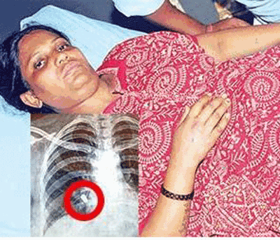 ಹೃದಯಾಘಾತ ಎಂದು ಆಸ್ಪತ್ರೆಗೆ ಹೋದ ಮಹಿಳೆಯ ಹೃದಯದೊಳಗಿತ್ತು ಬುಲೆಟ್ !